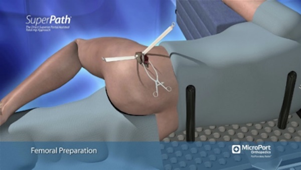 Posição para cirurgia de prótese de quadril